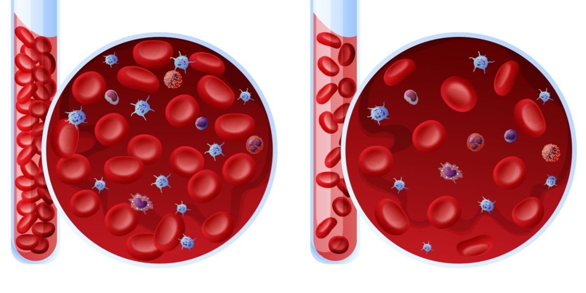 anemia aplásica médula ósea