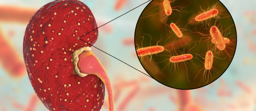 pielonefritis